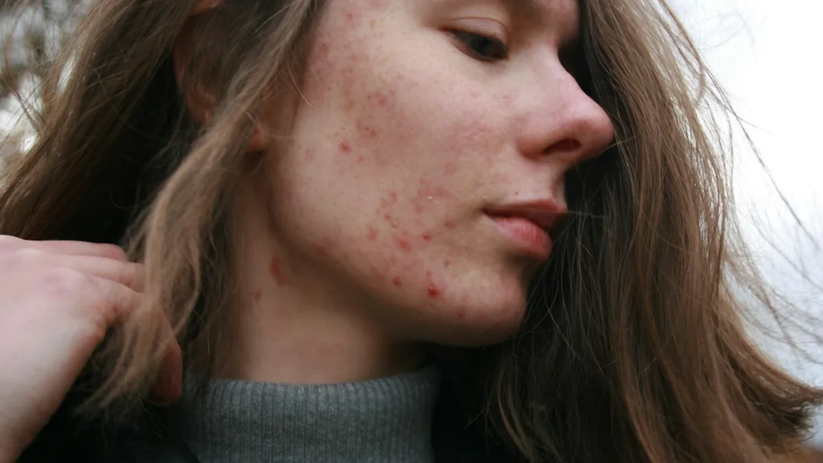 Comment enlever des boutons sur le visage